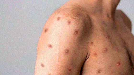 casos sospechosos de viruela simica en salta